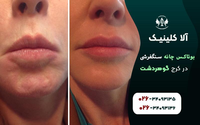 بوتاکس چانه سنگفرشی قبل و بعد