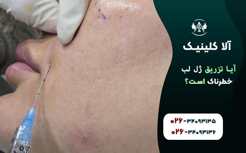 آیا تزریق ژل لب خطرناک است