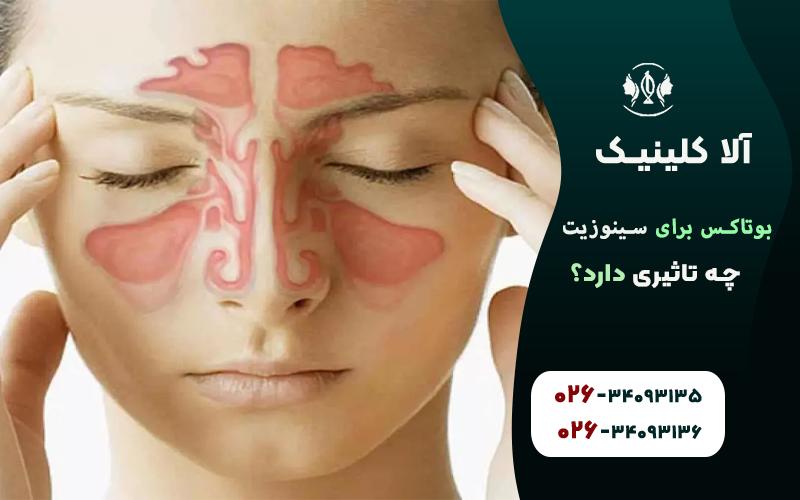 تاثیر تزریق بوتاکس برسینوزیت