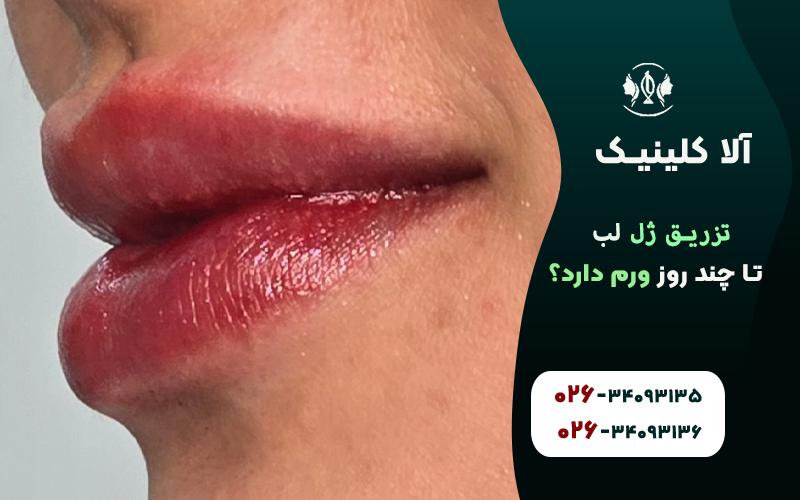تزریق ژل لب تا چند روز ورم دارد