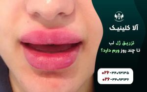 تزریق ژل لب تا چند روز ورم دارد