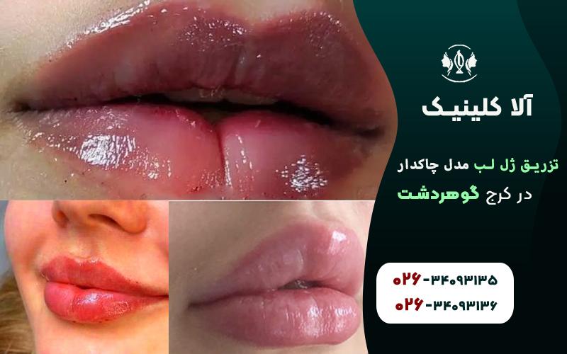 تزریق ژل لب مدل چاکدار