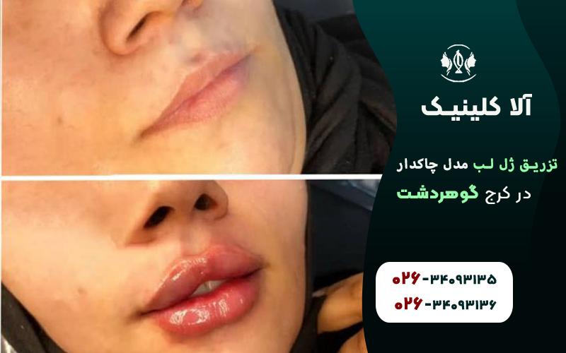 تزریق ژل لب چاکدار قبل و بعد