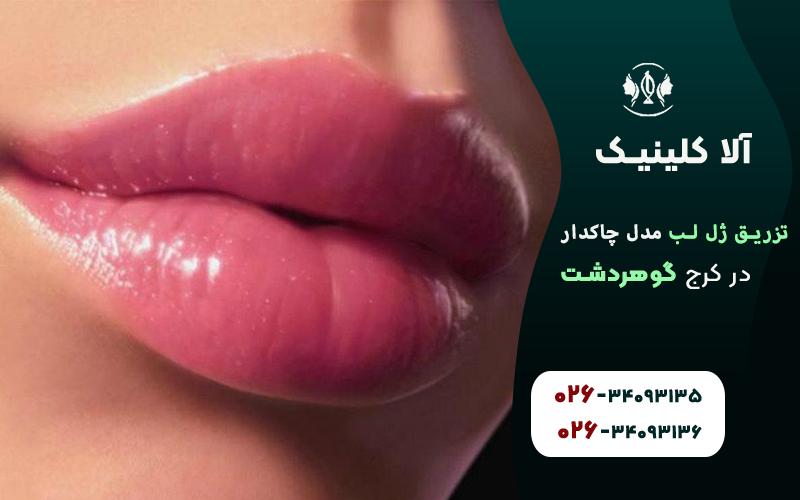 تزریق ژل لب چاکدار