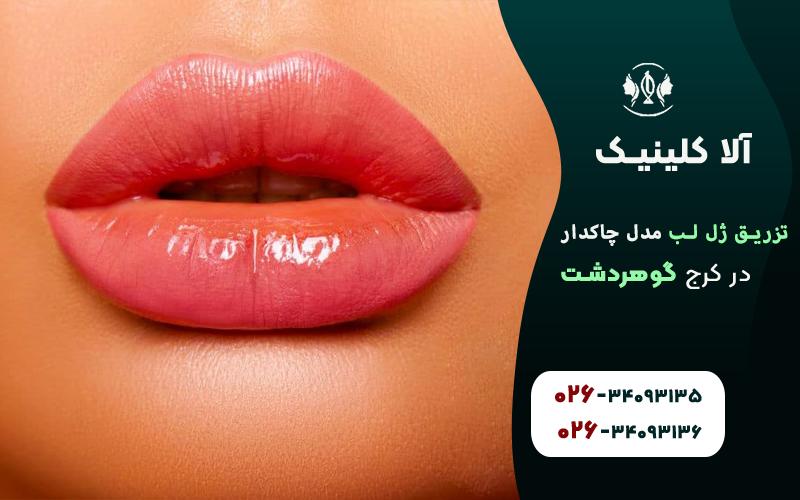 تزریق ژل لب مدل چاکدار
