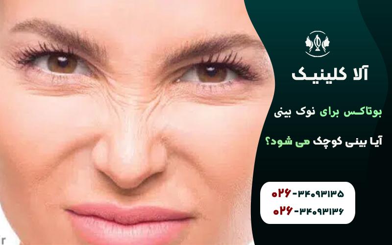 رفع چین و چروک های اطراف بینی با بوتاکس