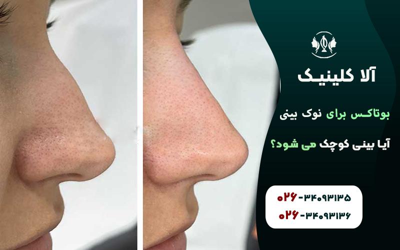 قبل و بعد بوتاکس نوک بینی