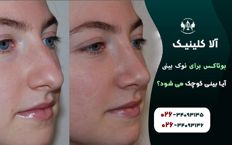 بوتاکس برای بالا بردن نوک بینی قبل و بعد