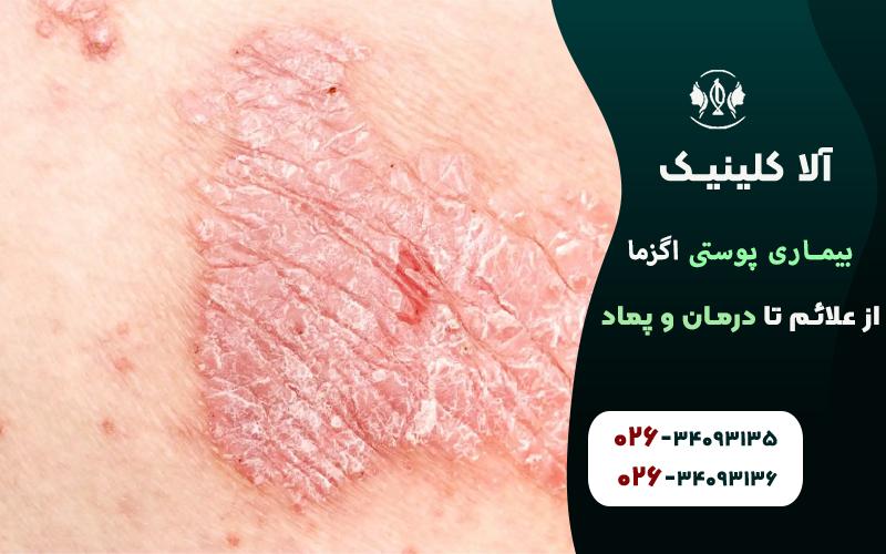 بیماری پوستی اگزما از علائم تا درمان و پماد