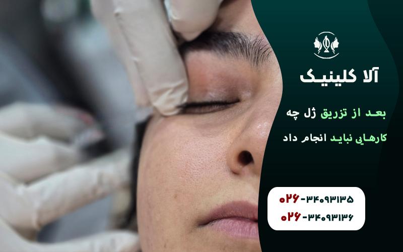 بعد از تزریق ژل چه کارهایی نباید انجام داد