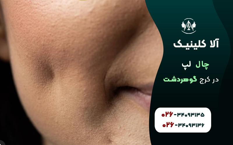 چال لپ هیدن طبیعی