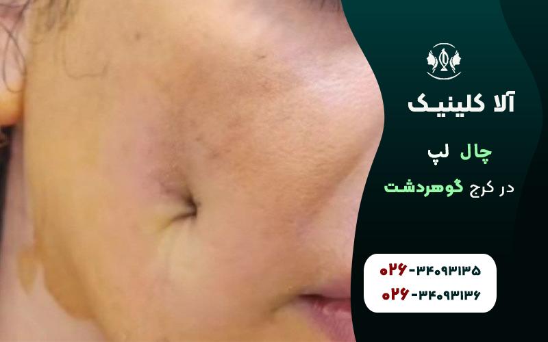چال لپ با نخ