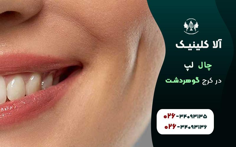 چال گونه در کرج