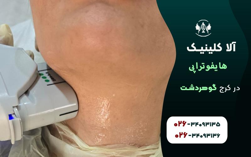 خدمات هایفوتراپی صورت در کرج