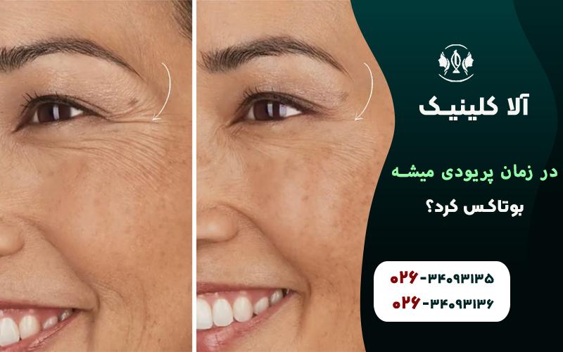 آیادر زمان پریودی میشه بوتاکس کرد