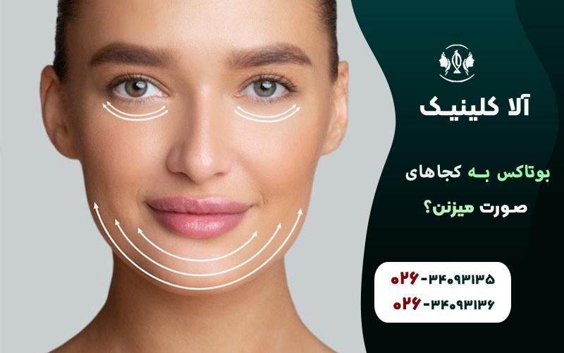بوتاکس برای چانه