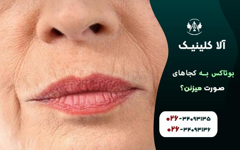 بوتاکس برای خطوط دور لب