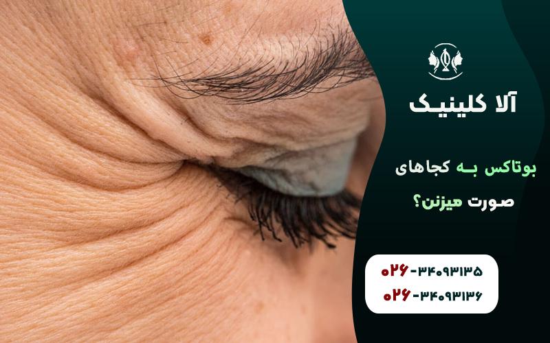 بوتاکس برای چروک های پنجه الاغی