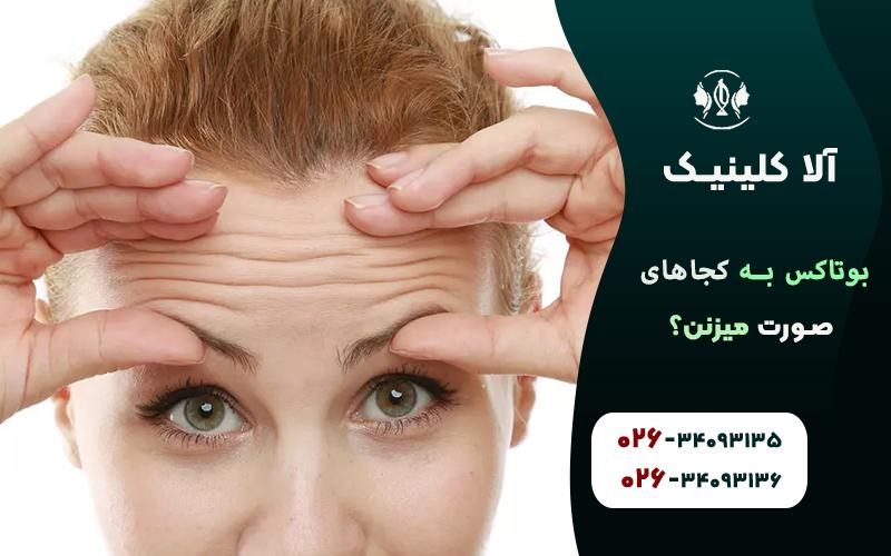 بوتاکس برای خطوط پیشانی