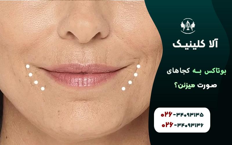 بوتاکس برای خطوط ماریونت