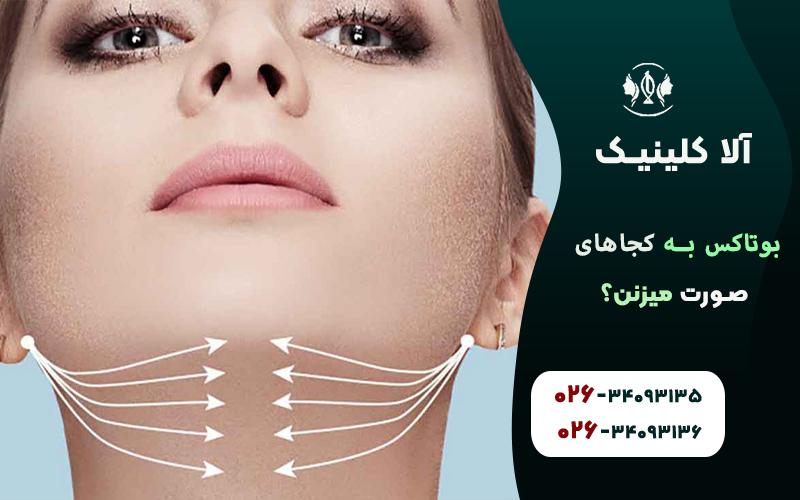 بوتاکس برای گردن