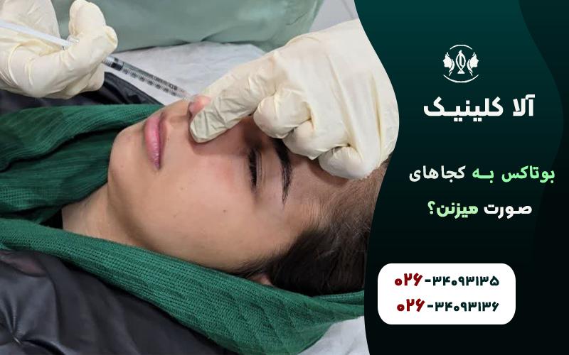 بوتاکس به کجاهای صورت میزنن
