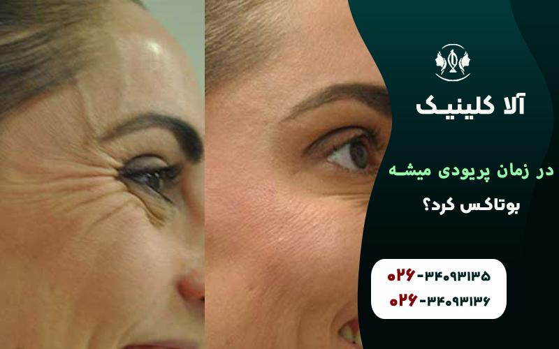 در زمان پریودی میشه بوتاکس کرد