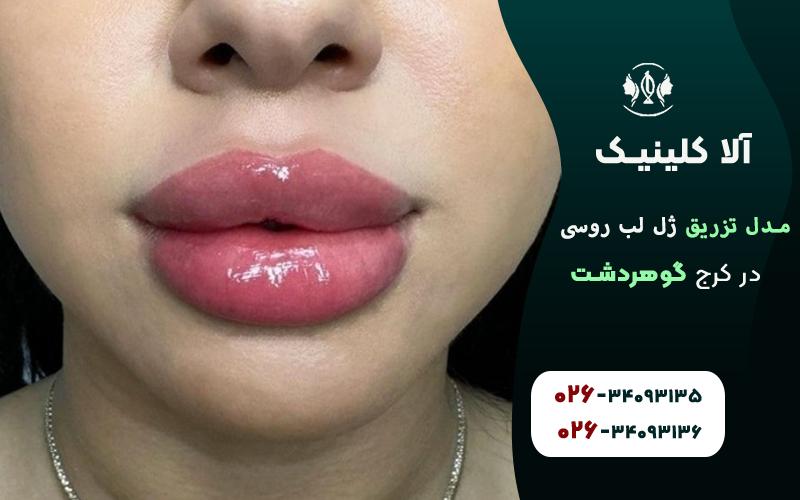تزریق ژل لب روسی عروسکی