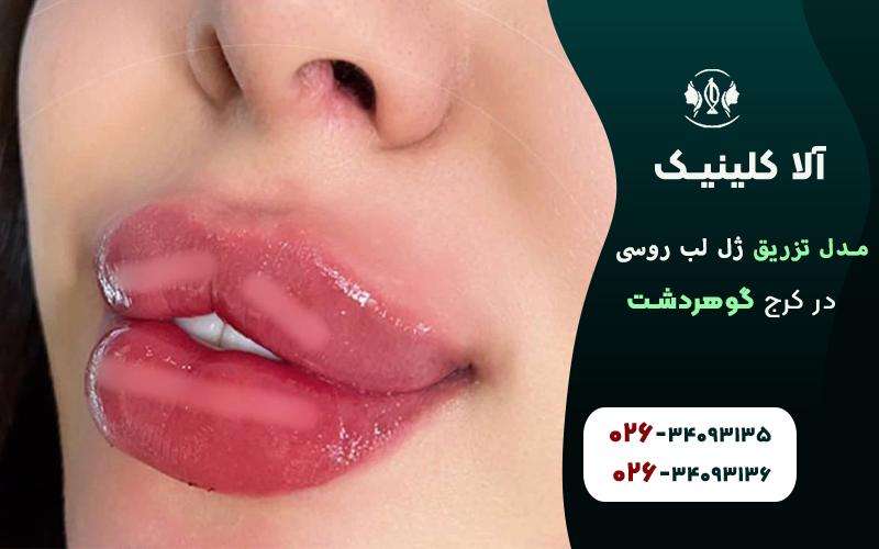 تزریق ژل لب روسی چاکدار