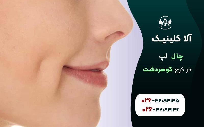 چال لپ در کلینیک آلا
