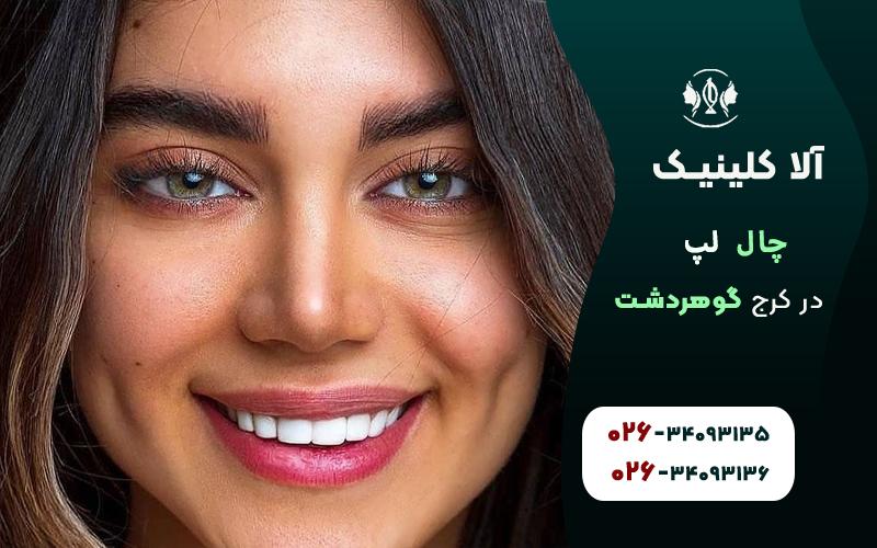 چال گونه کشیده