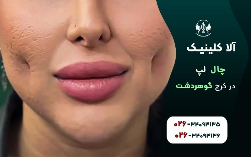 چال لپ در کرج