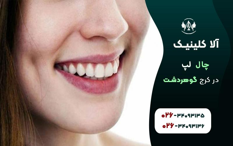 چال گونه در کرج