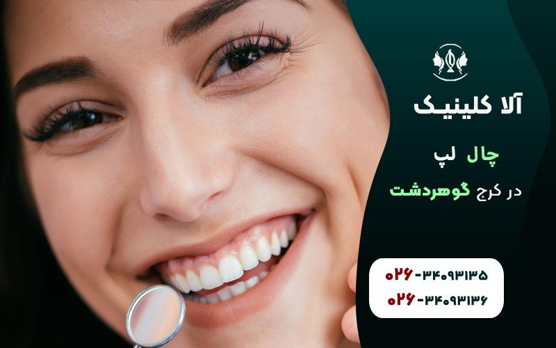 چال گونه یک طرفه