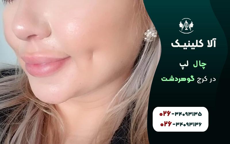 چال گونه طبیعی