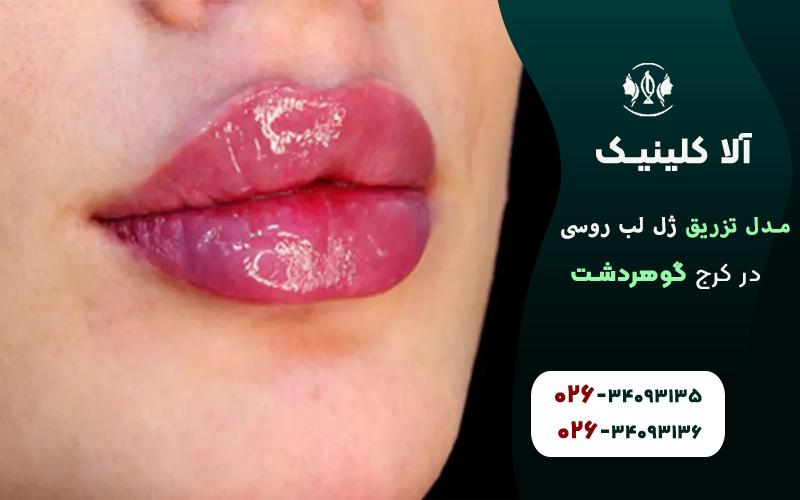 تزریق ژل لب مدل روسی عروسکی