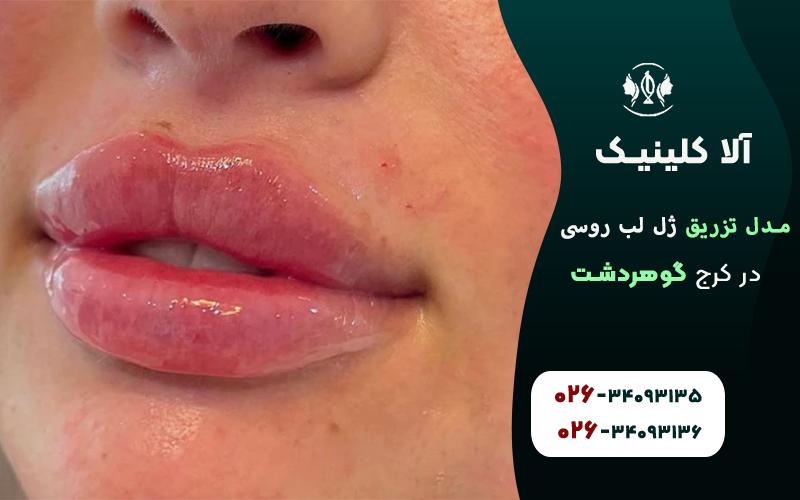 ژل لب مدل روسی چاکدار