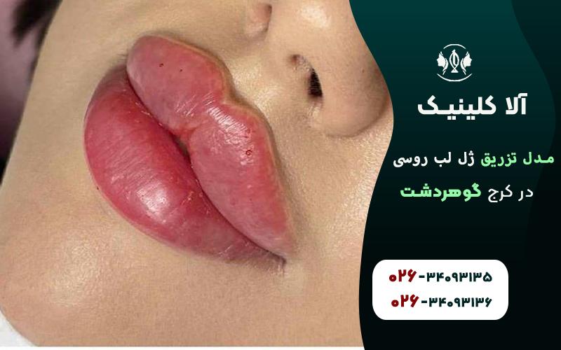 تزریق ژل لب روسی عروسکی چاکدار