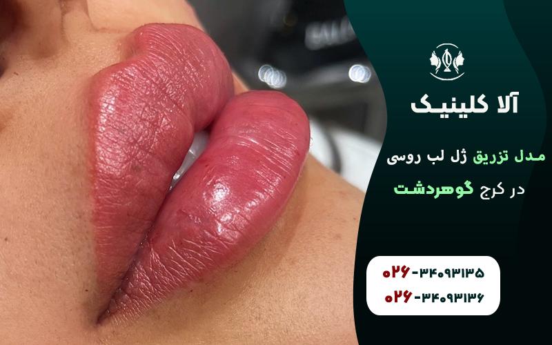 تزریق ژل لب مدل روسی عروسکی