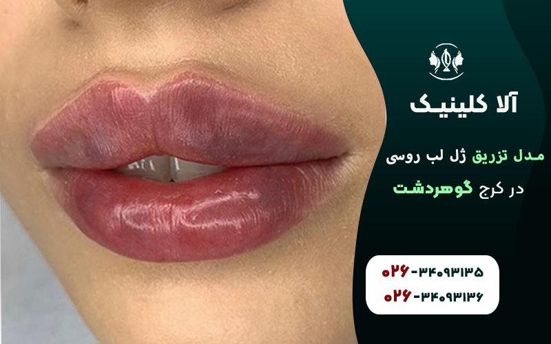 ژل لب مدل چاکدار روسی