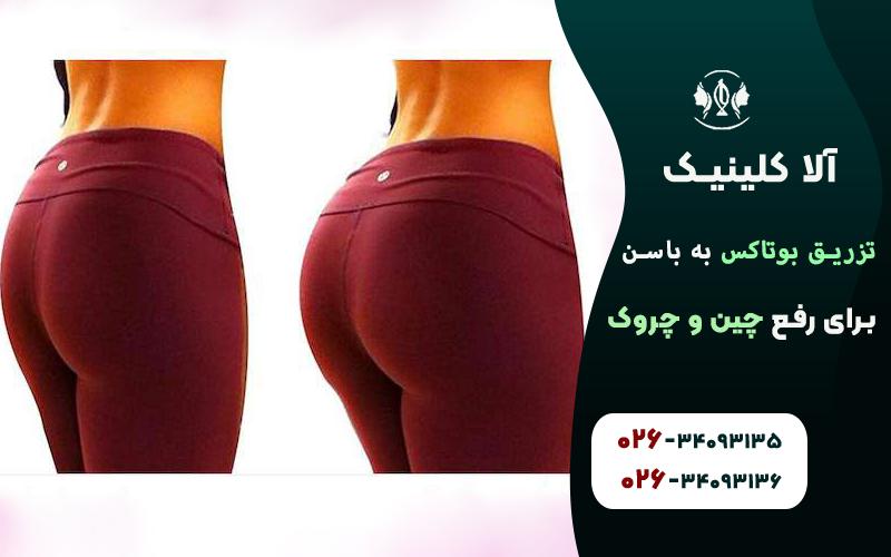 تزریق بوتاکس باسن قبل و بعد