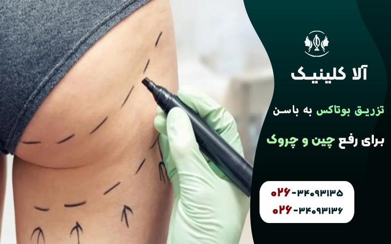 مراحل انجام تزریق بوتاکس باسن