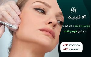 بوتاکس برای از بین بردن دندان قروچه