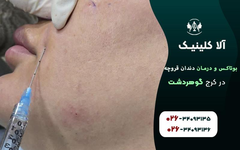 بوتاکس برای از بین بردن دندان قروچه