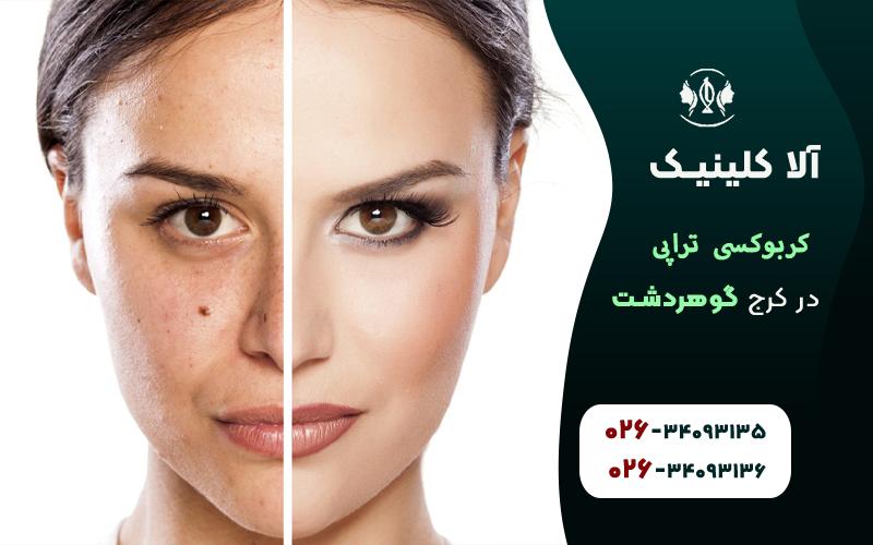 کربوکسی تراپی صورت در کرج