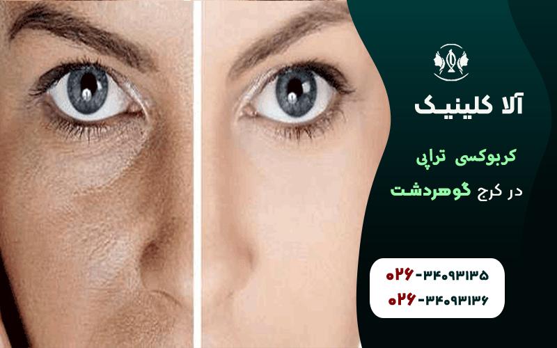 کربوکسی تراپی برای روشن شدن پوست در کرج