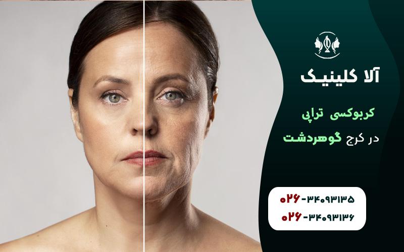 کربوکسی تراپی در کرج