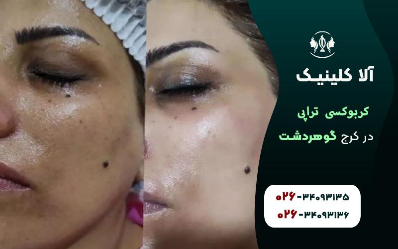کربوکسی تراپی پوست در کرج