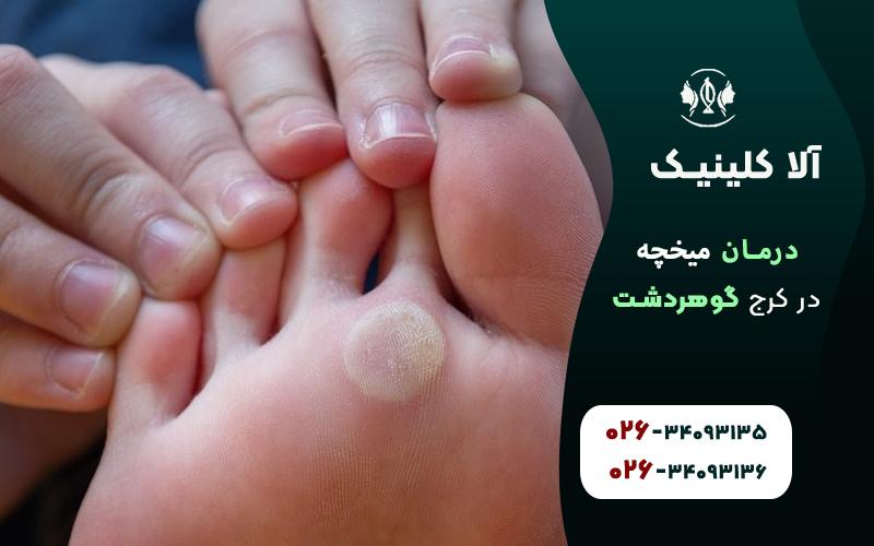 درمان میخچه در کرج