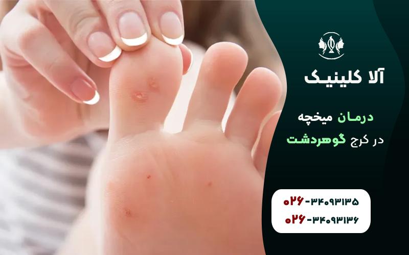 میخچه پا و درمان ان